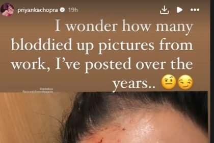 Priyanka Chopra: Actress Priyanka Chopra's accident on the sets, incident during filming in America, see photos