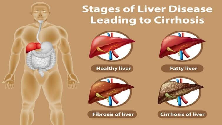 health tips autoimmune liver disease causes symptoms and treatment Liver Disease: तेजी से बढ़ रही ऑटोइम्यून लिवर डिजीज, जानें कितनी